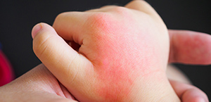 Eczema