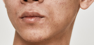 Hyperpigmentation