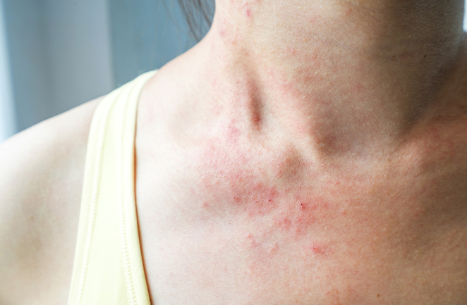 Woman with eczema on chest