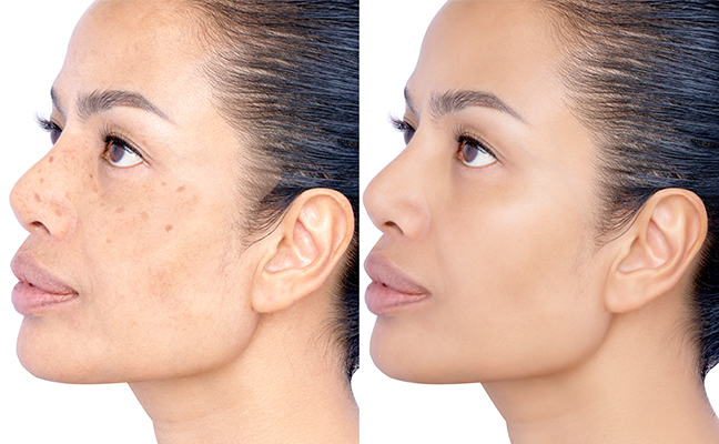 Before and after image of woman with hyperpigmentation