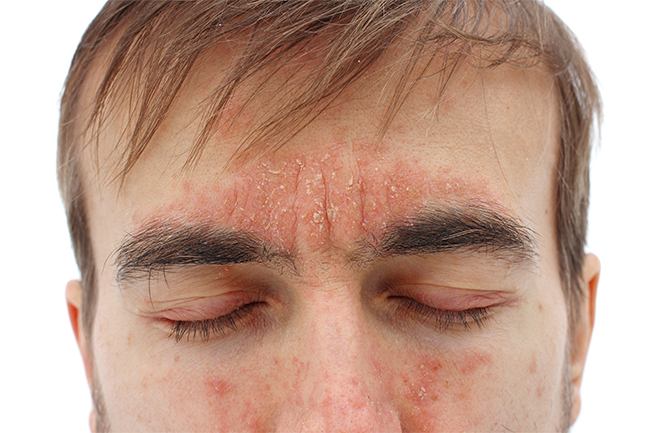 Man with Seborrheic Dermatitis