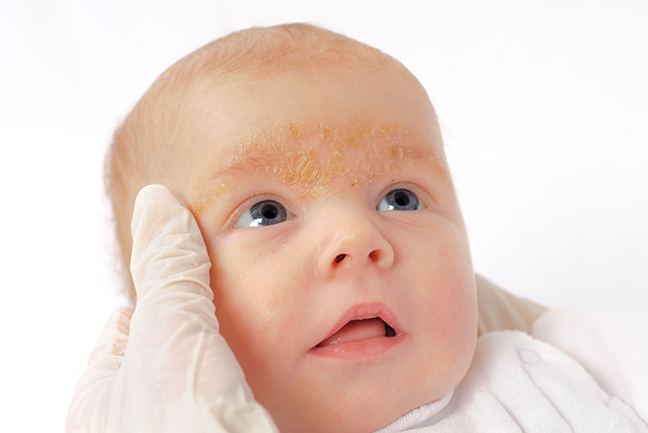Baby with Seborrheic dermatitis